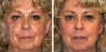 Scars Treatment