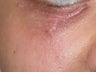 Scars Treatment