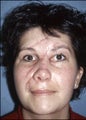 Facial Scar Improvement