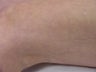 Sclerotherapy of spider veins