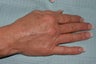 Sclerotherapy for hand veins