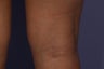 Sclerotherapy to Leg Veins