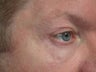 Sclerotherapy (eyelid)