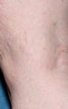 Sclerotherapy