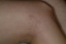 Sclerotherapy