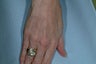 Sclreotherapy for the hands