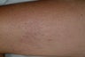 Sclerotherapy