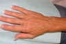 Sclerotherapy for hand veins
