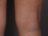 Sclerotherapy to Leg Veins