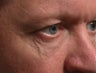 Sclerotherapy (eyelid)