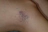 Sclerotherapy