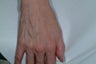 Sclreotherapy for the hands