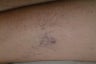 Sclerotherapy