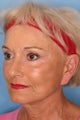 Sculptra Injections for Facial Volume Restoration 