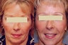 Sculptra treatments