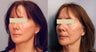Sculptra treatments