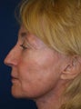 Sculptra Liquid Lift