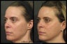 Sculptra