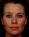 Sculptra