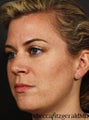 Sculptra /  IPL