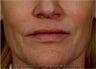 Sculptra, Botox, Juvederm and Restylane