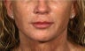 Sculptra, Juvederm, Obagi