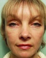 Liquid Facelift