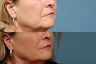Sculptra