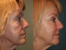 Sculptra