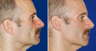 Sculptra
