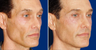 Sculptra