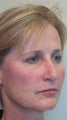 Sculptra and juvederm