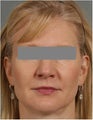 49 year old female treated for sagging under her eyes, cheeks and jaw line non surgically
