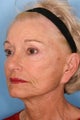 Sculptra Injections for Facial Volume Restoration 