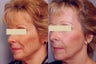 Sculptra treatments