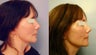 Sculptra treatments