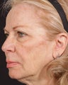 Sculptra