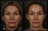 Sculptra