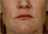 Sculptra, Botox, Juvederm and Restylane