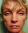 Liquid Facelift
