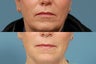 Sculptra  area around mouth