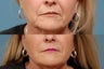 Sculptra