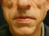 Sculptra