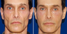 Sculptra