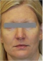 49 year old female treated for sagging under her eyes, cheeks and jaw line non surgically