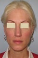 Rhinoplasty and Septoplasty
