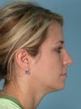 Rhinoplasty