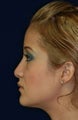 Rhinoplasty and Septoplasty