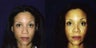 Rhinoplasty and Septoplasty