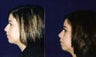 Rhinoplasty and Septoplasty